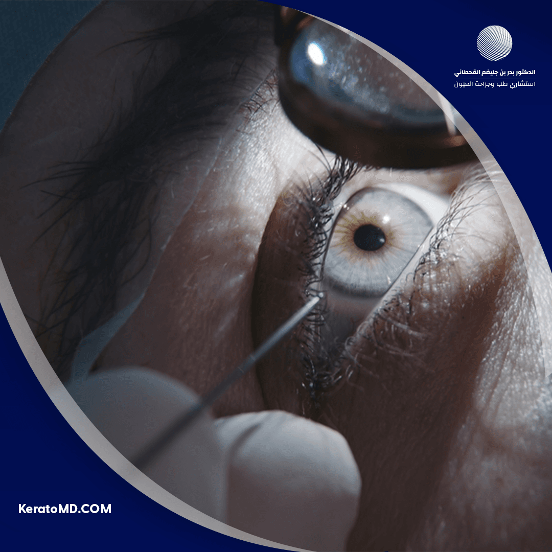 أفضل دكتور تصحيح نظر في الحبيب