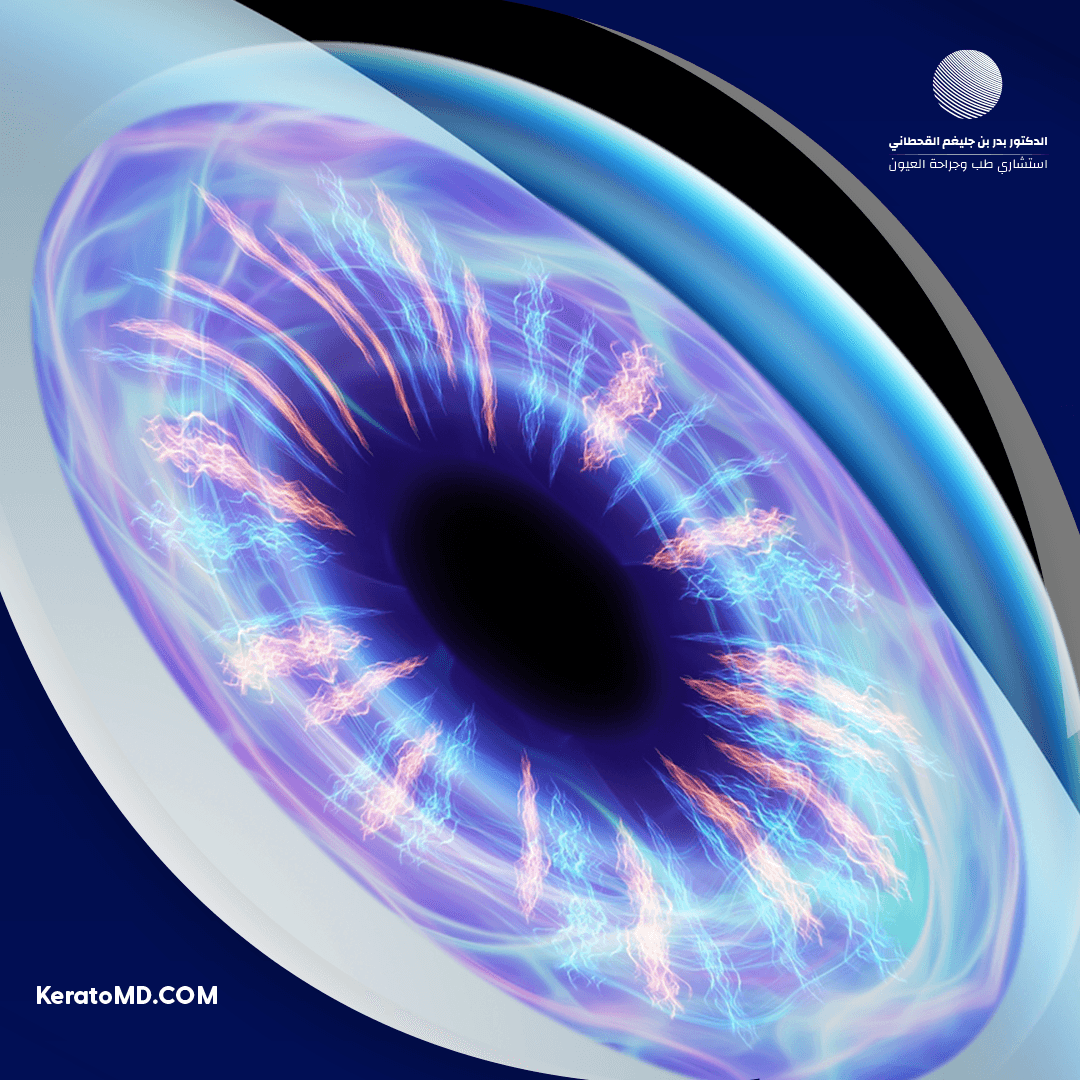 أفضل دكتور قرنية مخروطية