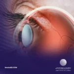 سبب المياه البيضاء