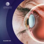 سبب المياه البيضاء